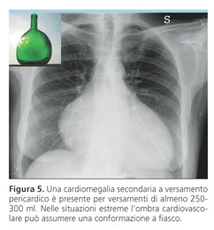 Dieci quesiti in tema di versamento pericardico | Giornale Italiano di  Cardiologia