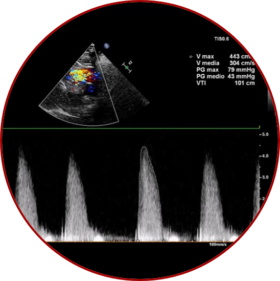 Una stenosi aortica «discordante»